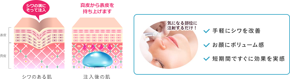 気になる部位に注射するだけ！ 手軽にシワを改善 お顔にボリューム感 短期間ですぐに効果を実感
