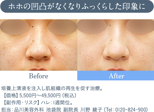 ホホの凹凸がなくなりふっくらした印象に 培養上清液を注入し肌組織の再生を促す治療。【価格】5,500円～49,500円（税込）　【副作用・リスク】ハレ：1週間位。担当：品川美容外科 池袋院 副院長 川野 綾子（Tel：0120-824-900）