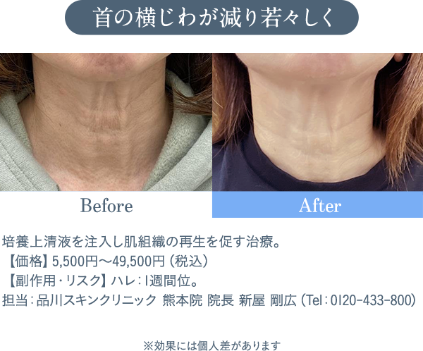 首の横じわが減り若々しく 培養上清液を注入し肌組織の再生を促す治療。【価格】5,500円～49,500円（税込）　【副作用・リスク】ハレ：1週間位。担当：品川スキンクリニック 熊本院 院長 新屋 剛広（Tel：0120-433-800）