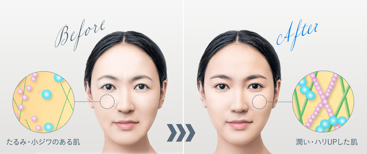 Before たるみ・小ジワのある肌 After 潤い・ハリUPした肌