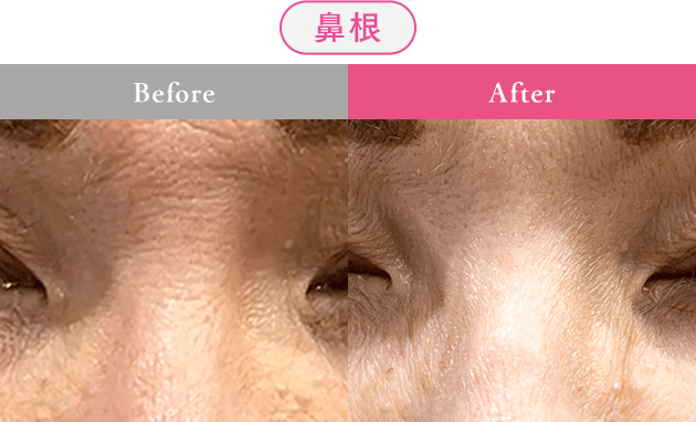 鼻根 Before After