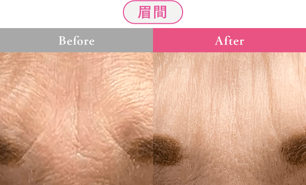 眉間 Before After