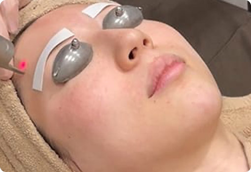 ピコレーザーの照射