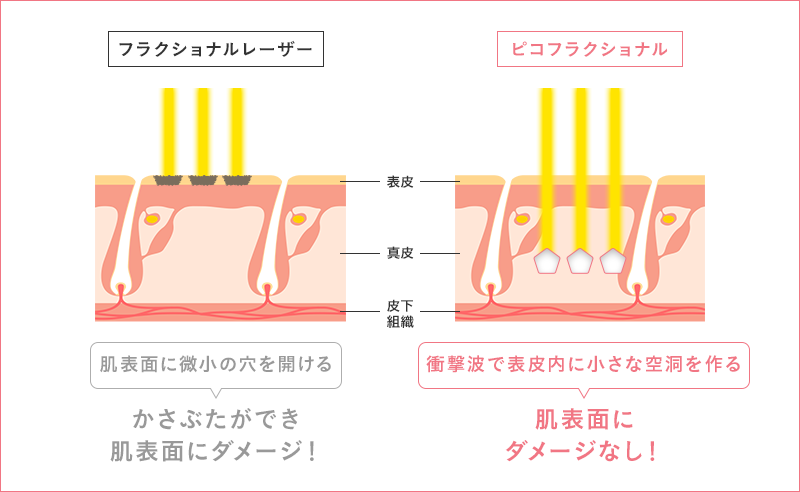 フラクショナルレーザー治療との違いイメージ