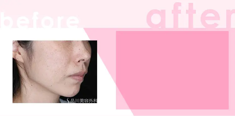 かゆみ:わずかなかゆみ 治療間隔:3週間以上空けて数回