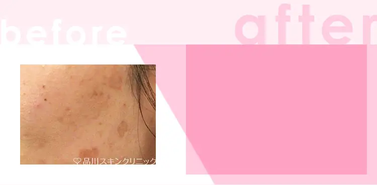 かゆみ:わずかなかゆみ 治療間隔:3週間以上空けて数回