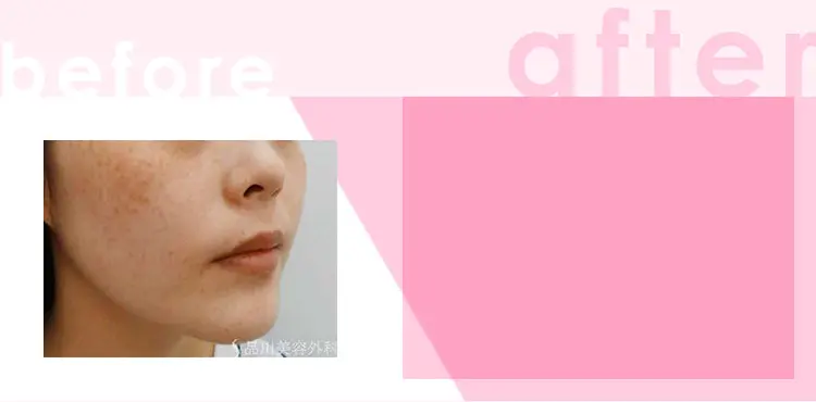 かゆみ:わずかなかゆみ 治療間隔:3週間以上空けて数回