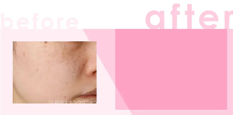 かゆみ:わずかなかゆみ 治療間隔:3週間以上空けて数回