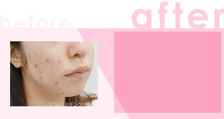 かゆみ:わずかなかゆみ 治療間隔:3週間以上空けて数回