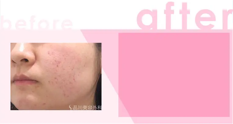 かゆみ:わずかなかゆみ 治療間隔:3週間以上空けて数回